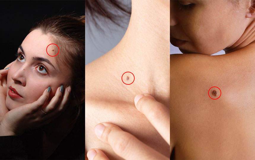What is an unlucky mole on a female body?